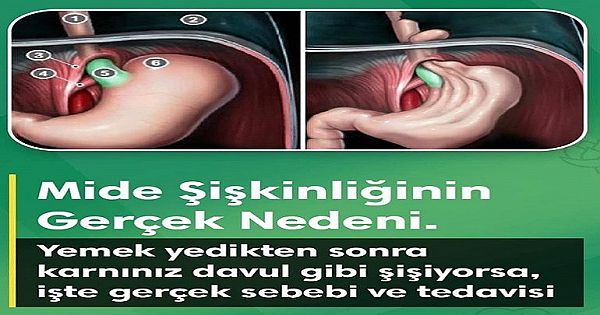 Mide Şişkinliğinin Gerçek Nedeni ve en doğal tedavi yöntemi