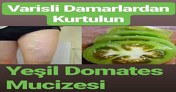 Yeşil Domates ile Varisli Damarlardan Kurtulmak